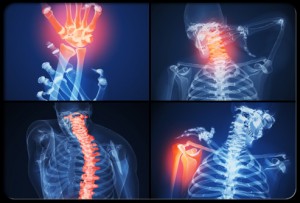 Arthritis in the spine